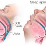 The Role of Oral Surgery in Treating Sleep Apnea