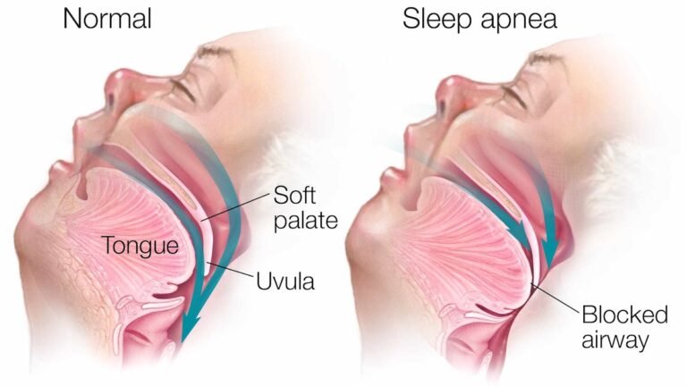 The Role of Oral Surgery in Treating Sleep Apnea