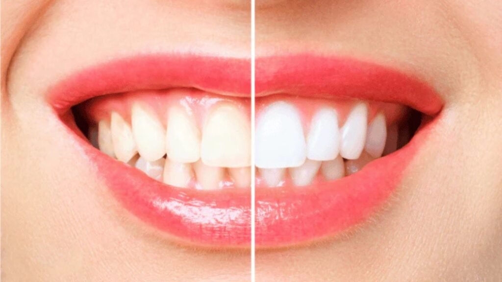 The Science Behind Teeth Whitening: How Does It Work?