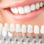 Top Teeth Whitening Methods: What Works Best?