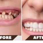 What to Expect Before and After Oral Surgery