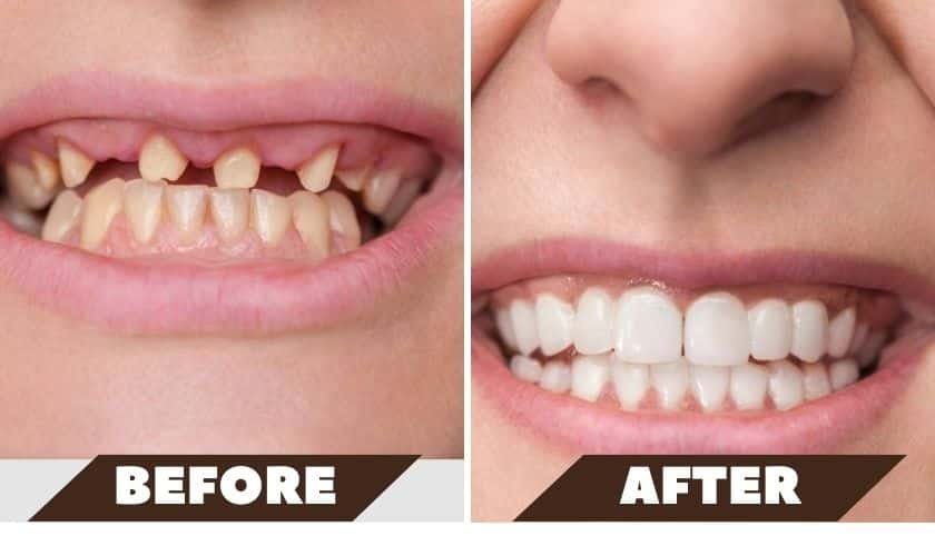 What to Expect Before and After Oral Surgery