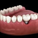 Who is a Good Candidate for Dental Implants?