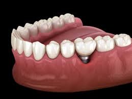 Who is a Good Candidate for Dental Implants?