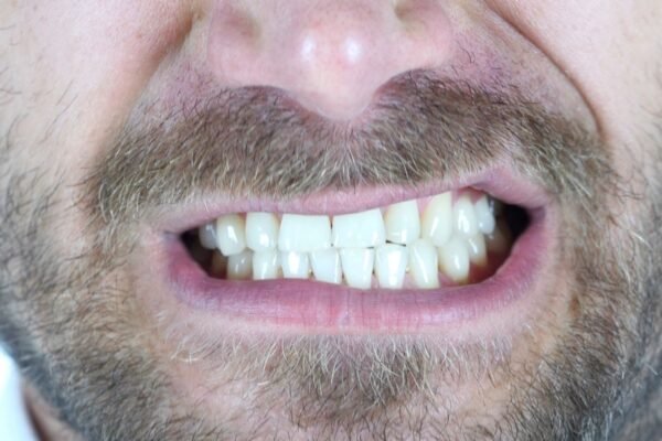 How to Avoid Teeth Grinding During a Poker Game